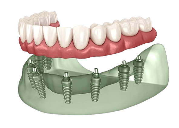 Clear aligner smile